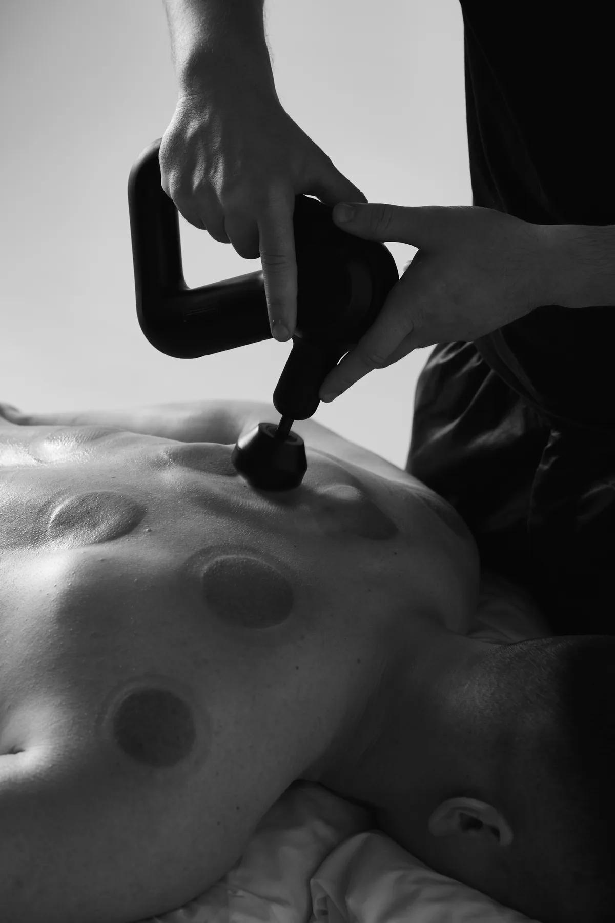 Theragun therapy κατ’ οίκον στην Αθήνα: κρουστική συσκευή σε πλάτη με σημάδια βεντουζών
